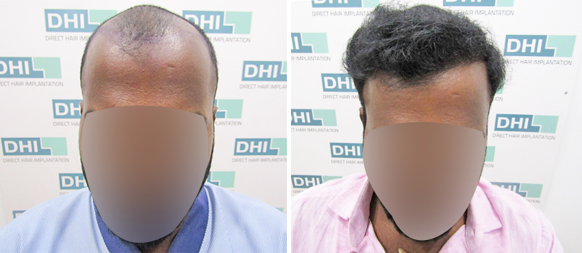 DHI before & after hair transplant results